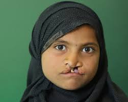 Image result for Cleft Lip