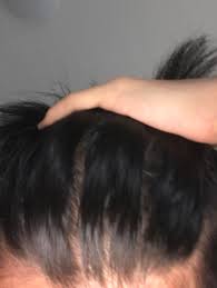 I still am not sure if this is diffuse thinning or if my hair just clumped up funny and is naturally thin. Early Diffuse Thinning Hairloss