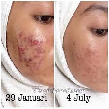 Pelbagai kaedah terbaik hilangkan masalah gegata yang menyeksakan anda! P Petua Hilangkan Parut Jerawat Dan Jeragat Dengan Cepat