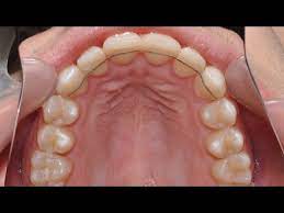 The Broken Fixed Retainer Athanasios Tom Nasiopoulos Specialist Orthodontist Youtube