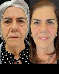 Uma aparência mais jovem, com um olhar descansado e um perfil impecável!  👌😍 Dra. Elisa Simon Marczak