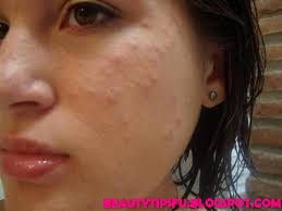 You can read in this page garmi danay ka ilaj, garmi dano ka ilaj in urdu, balo ke liye totkay urdu, totkay for high blood pressure in urdu, desi totkay for . Home Remedies For Garmi Danay On Face Garmi Dano Se Nijat In Urdu Garmi Dano Ka Gharelu Ilaj Garmi Danay Treatment Garmi Dano Ka Powder In Hindi Beauty Tips For You