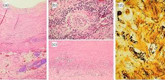Image result for Cardiovascular Syphilis