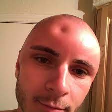 Let This Dent In A Dude S Head Remind You To Wear Sunscreen