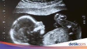 Selain dua kondisi gambaran hasil usg kehamilan 5 minggu yang ditunjukan diatas, beberapa ibu hamil terkadang sudah dapat terlihat adanya janin di dalam kantung kehamilan. Risiko Bayi Lahir Dengan Berat Badan Rendah Bisa Dideteksi Dengan Usg