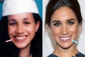 Meghan Before And After New Teeth Veneers Beautiful Teeth Meghan Markle Nose Job Veneers Teeth