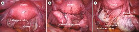 Laparoscopic demonstration of pelvic anatomy by dr r k mishra at world laparoscopy hospital. Female Subfertility Nature Reviews Disease Primers
