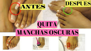 Con Una Vez Que Pruebes Esto Para Las Manchas Oscuras En La Piel How To Get Rid Of Dark Knucles Youtube