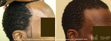 Clarifies the medication minoxidil (rogaine for men and woman) a drug that increases hair growth. Beard And Side Burn Hair Transplant Transplant Wrassman M D Baldingblog