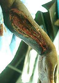 Necrotizing fasciitis represents a group of rare but highly lethal bacterial infections characterized by rapidly progressing inflammation and necrosis of skin and soft tissue 1). Necrotizing Fasciitis Practice Essentials Background Pathophysiology