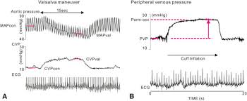 Like most models, there are certain inherent assumptions. Assessment Of Central Venous Physiology Of Fontan Circulation Using Peripheral Venous Pressure The Journal Of Thoracic And Cardiovascular Surgery