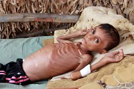 Keep your arms by your sides with your palms facing down. Yemeni Boy Fights Malnutrition As Hunger Stalks Nation S Children The Star