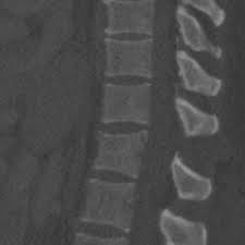 Image result for Chance Fracture