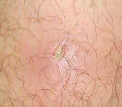 The groin area is the area on either side of the body where the stomach meets the legs. Treating Saddle Sores Tailwind Coaching Prevention Treatment