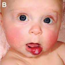 3 yrs ago, dry lip, split and bled. Pdf Infantile Hemangiomas Of The Lip Complications And Need For Surgical Intervention