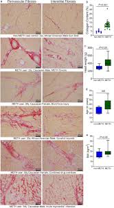For other uses, see meth (disambiguation). Methamphetamine Induces Cardiomyopathy By Sigmar1 Inhibition Dependent Impairment Of Mitochondrial Dynamics And Function Communications Biology