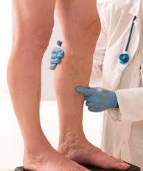 Hesperidin is also one of the common ingredients which are best for treating varicose veins and spider veins. 8 Simple Tips To Manage Varicose Veins