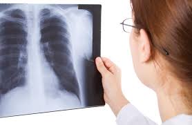 Image result for Acute Bronchitis