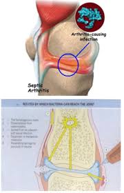 Image result for Septic Joint