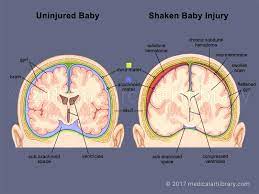 Shaken Baby Syndrome Medical Art Library