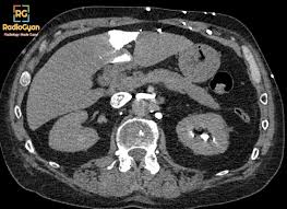 Sign up for a free github account to open an issue and contact its maintainers and the community. Hot Quadrate Lobe Sign Radiology Cases Radiogyan Com