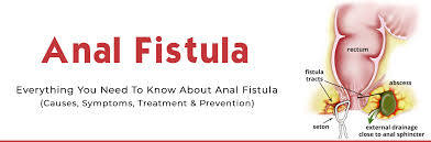 They can develop anywhere between an intestine and the skin. Anal Fistula Causes Symptoms And Prevention