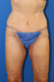 Thigh Lift Surgery Austin Tone Firm Smooth Your Thighs