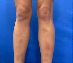Image result for erythema nodosum