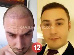 زراعة الشعر في تركيا قبل وبعد 8 اشهر زراعة 4500 بصيلة بتقنية الاقتطاف 00905444488340 Www Camiliaclinic Com Hair Transplant Hairstyles Plastic S