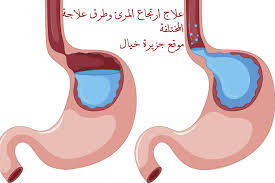 ماهي اعراض ارتجاع المريء وطرق علاجه بالاعشاب