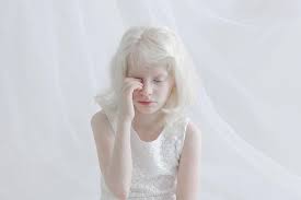 A person or animal with white skin and hair and pink eyes 2. Photographers Capture The Unique Beauty Of Albino People And People Can T Stop Loving Them