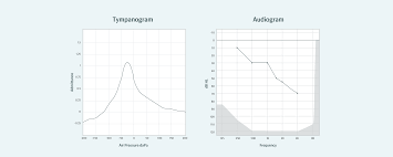 Image result for Tympanometry