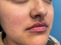 Dallas, TX Restylane®: The ZO Skin Centre Dallas