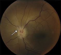 Image result for Optic Neuritis