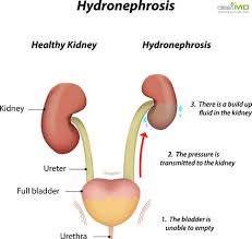 Hydronephrosis A Kidney Disorder Kidney Kidney Stones Symptoms Kidney Health