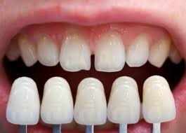 Today, teeth gaps are attractive. Want To Fix Your Tooth Gaps For Good Try Porcelain Veneers