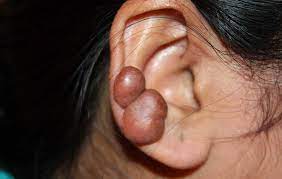 How do you heal swollen pierced ears? Cartilage Piercing Bump Scars Infections And What To Do