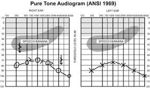 What Is An Audiogram Canadian Hearing Society