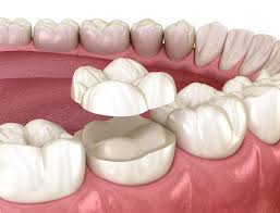 Image result for Tooth Attrition