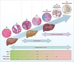 Image result for Fibrosis Probability Score
