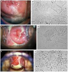 Image result for Vaginitis