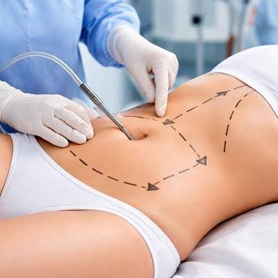 Best Liposuction Surgeon in Dubai & Abu Dhabi | Fat Removal Surgeon's
