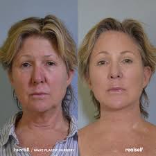 Pin On Before And After Results
