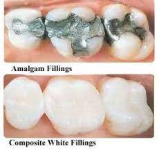 5.2 how much does a white filling cost in the uk with a private dentist? Mercury Filling Removal And Cost A Complete Guide 2020