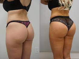 3) as a rule of thumb, the average industry cost starts at $6,500, the median is $8,500 and the high point is $10,000. Brazilian Butt Lift For Chandler Scottsdale Az Dr Josh Olson