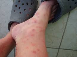 Ewww A Picture Of Someone S Foot With Bed Bug Bites Bed Bug Bites Bed Bugs Treatment Bed Bugs