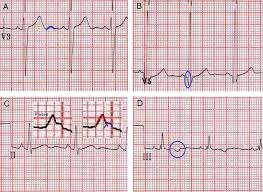 Or >25% of associated r wave; Acadoodle