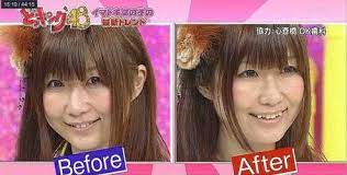 This starter kit includes six months' worth of peroxide pens and an led light. Diy Teeth Straightening And Other Dangerous Ortho Trends Dr Fagala