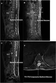Image result for Spinal Epidural Abscess