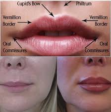 Lip Augmentation At Laser Clinique Dermal Fillers Lip Augmentation Lip Fillers